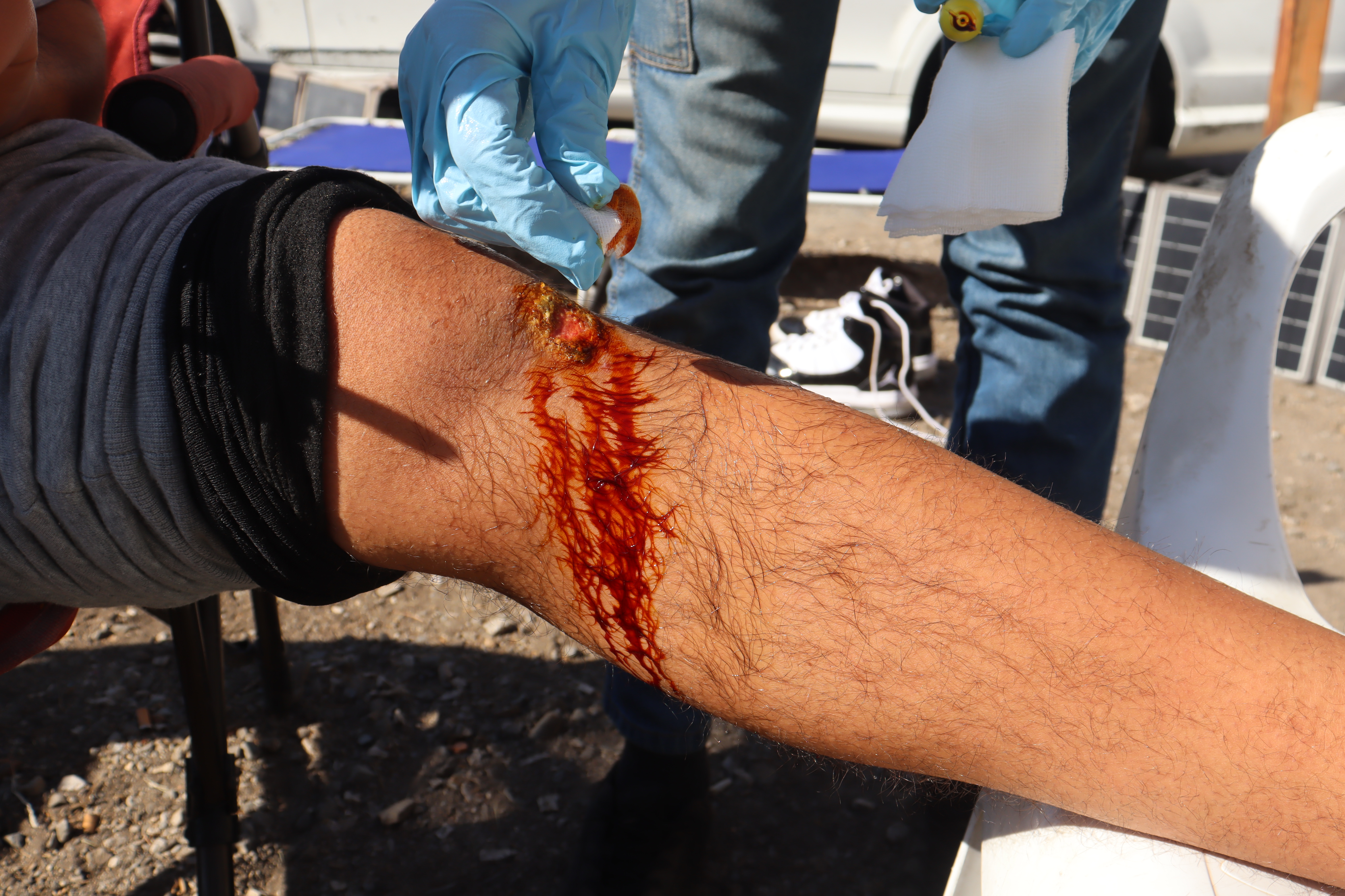 Omar et sa blessure